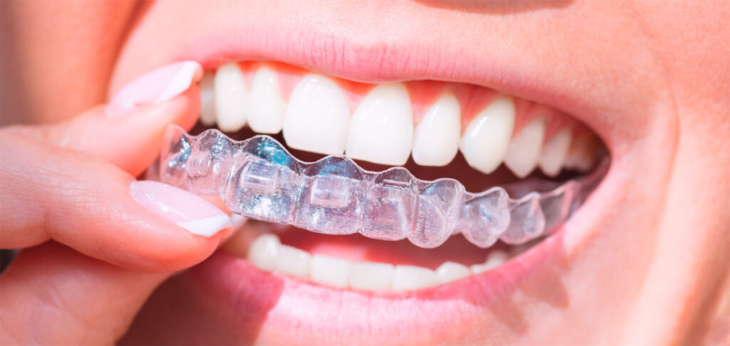 Invisalign